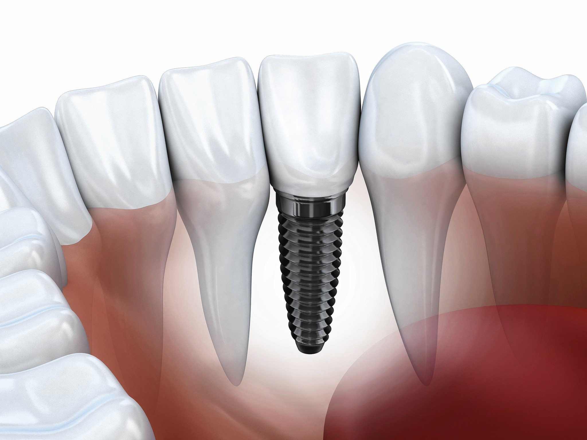 Best Ways to Choose Dental Clinic in Delhi for Dental Implants